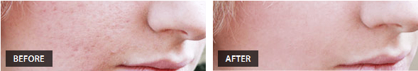 Acne Scars