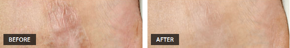 Burn Scars