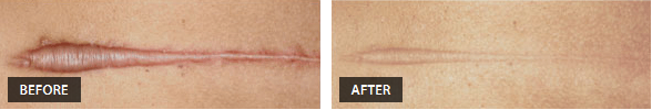 Hypertrophic Scars