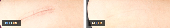 Surgery Scars